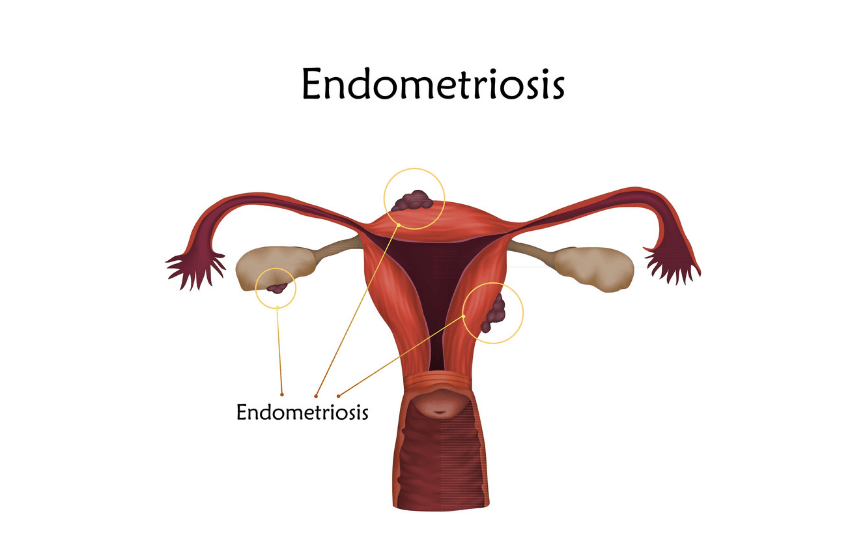 endometriosis síntomas y causas